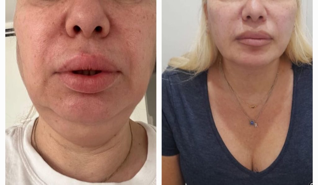 סנטר כפול נדיר